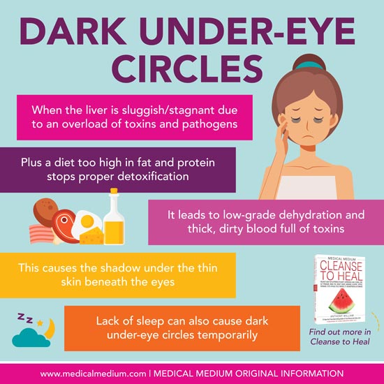 Dark Circles Under Eyes, Causes, Treatment