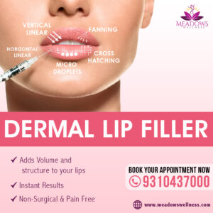 Dermal Lip Filler